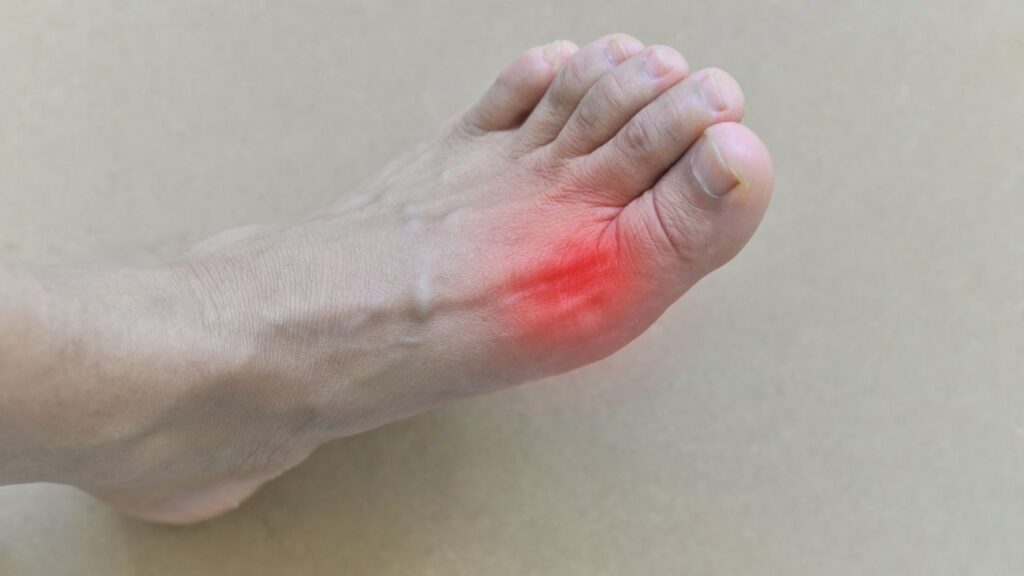 Gout - aching foot